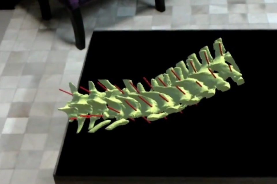 Imagem de Orgulho nacional! Médicos brasileiros usam Hololens em cirurgia de coluna no tecmundo